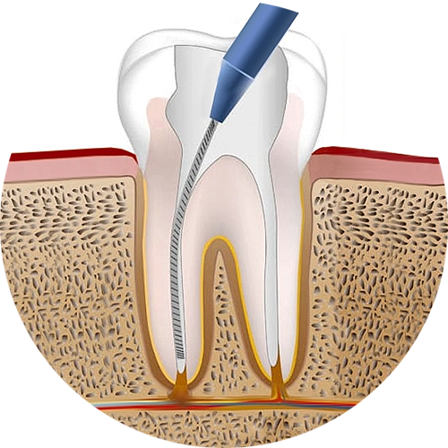 Эндодонтия 2