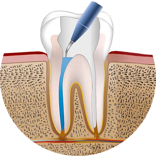 Эндодонтия 3