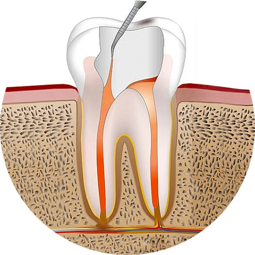 Эндодонтия 4