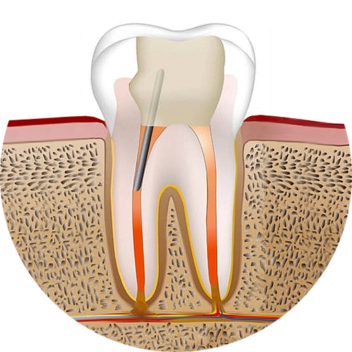 Эндодонтия 5