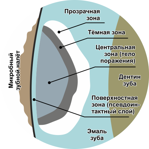 дентальный имплант
