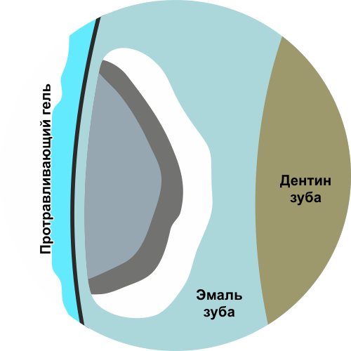 дентальный имплант
