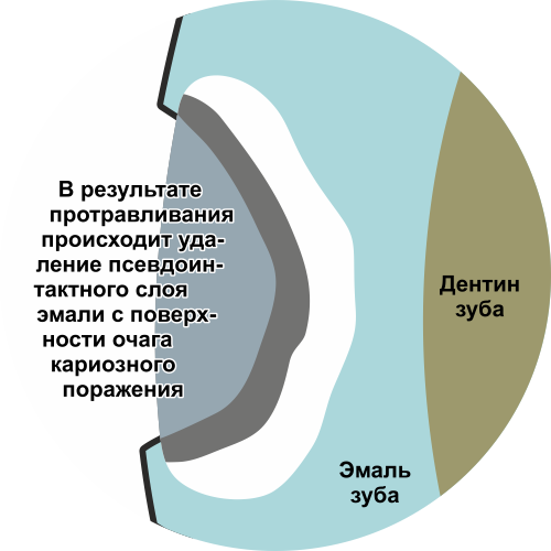 дентальный имплант