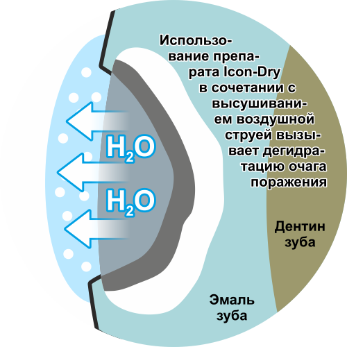 дентальный имплант