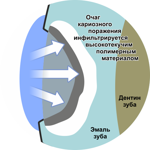 дентальный имплант