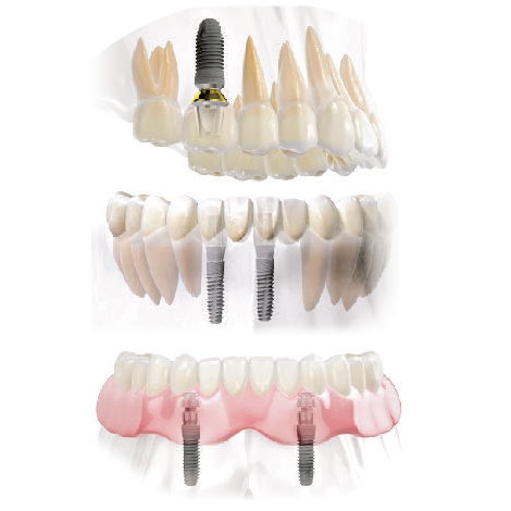 дентальный имплант