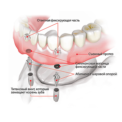 дентальный имплант