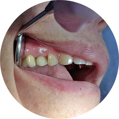 Коронка с опорой на имплант