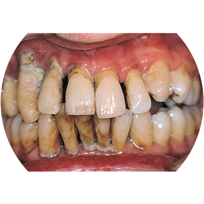 Агрессивный пародонтит
