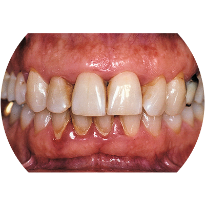 Пародонтит средней степени