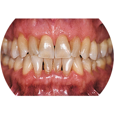 Отсутствие пародонтита