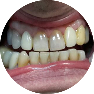 Работы ПрофиСтом - реставрация. До...