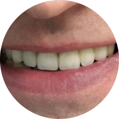 Работы ПрофиСтом - реставрация. После...