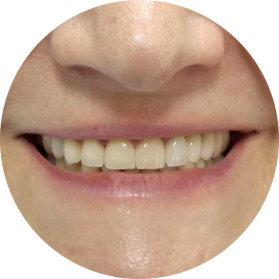 Работы ПрофиСтом - реставрация. После...