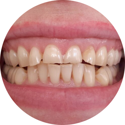 Работы ПрофиСтом - реставрация. До...