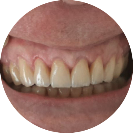 Работы ПрофиСтом - реставрация. После...